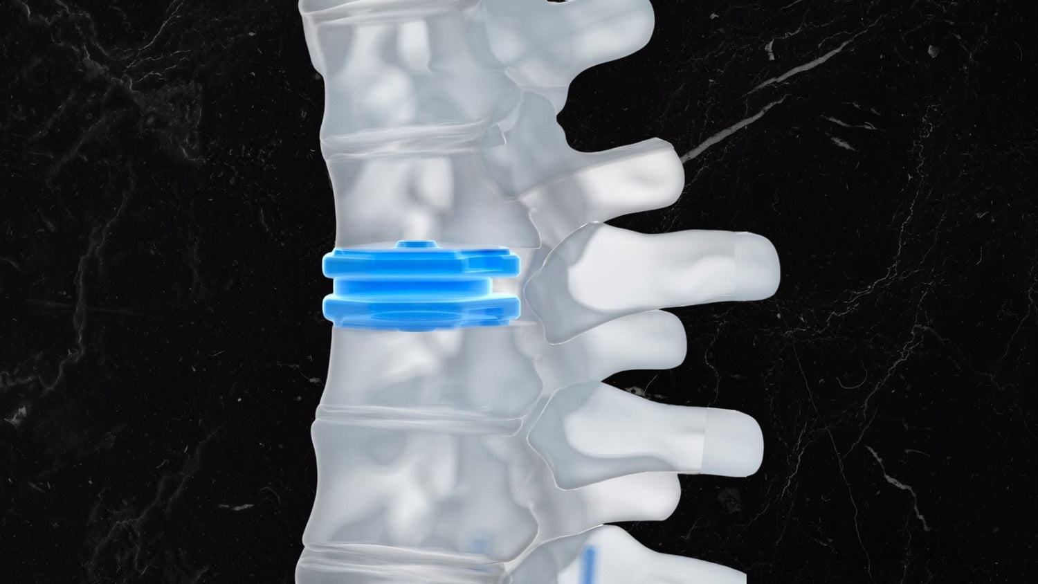 Disc replacement xray imaging
