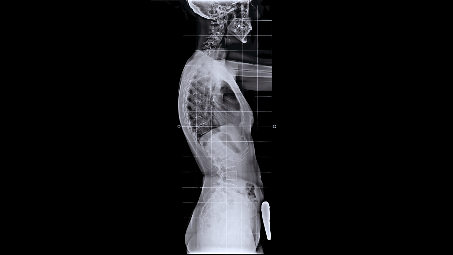 Grayscale X-ray of human skeleton profile with kyphosis, showing spine, ribs, pelvis